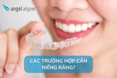 Các trường hợp cần niềng răng